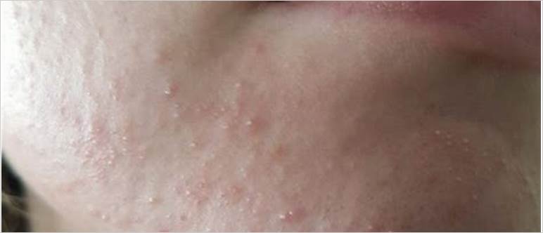 Acne from mold
